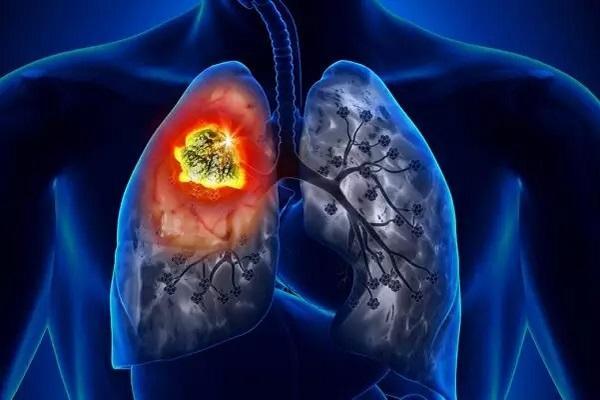 علائم سرطان ریه را بشناسید، چه کسانی می توانند مبتلا شوند
