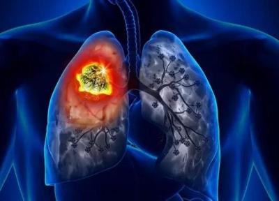 علائم سرطان ریه را بشناسید، چه کسانی می توانند مبتلا شوند